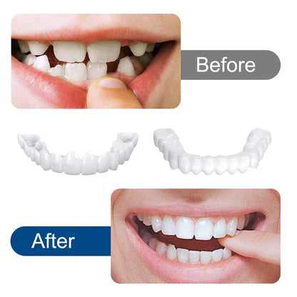 SnapOn Smile Dental Veneer