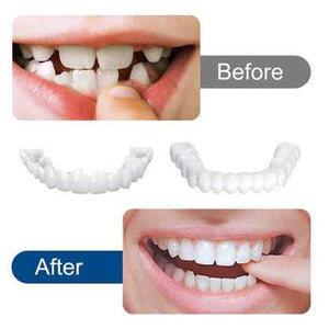 SnapOn Smile Dental Veneer