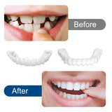SnapOn Smile Dental Veneer